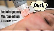 Radiofrequency Microneedling | Does it actually work? | Dermatologist reviews
