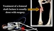 Fracture of the Femur and its fixation - Everything You Need To Know - Dr. Nabil Ebraheim