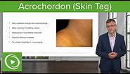 Acrochordon (Skin Tag): Dermatology | Lecturio