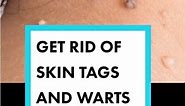 Get rid of skin tags and warts in 24 hours. #skintags #warts #wartremoval #skintagremoval #health #love #cancer #diet #lifestyle #nomeds #healnow #dailyvid #viral #longevity #healing | Paul Fortin