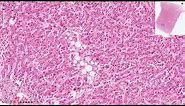 Hepatic Steatosis - Histopathology (+ Normal Liver Histology)