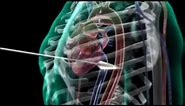 Arrow Through Human Heart - 3D Medical Animation || ABP ©