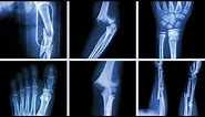 What Happens To Your Body When You Break A Bone