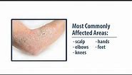 Common Skin Disorders- Eczema & Psoriasis