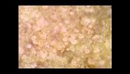 Scabies mites on skin crust