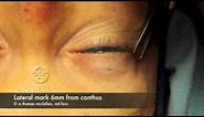 Live Surgery: Upper Blepharoplasty (Eyelid Lift) Part 1: Markings and Anesthesia