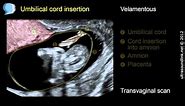 Velamentous insertion of the umbilical cord