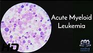 Acute Myeloid Leukaemia: Everything You Need To Know