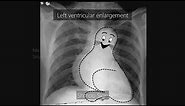 Cardiac borders and chambers in Chest X Ray