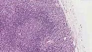 Histopathology Lymph node--Nodal marginal zone B-cell lympho