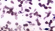 Blood Sickle Cell Anemia