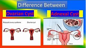 Difference Between Ovarian cyst and Adnexal Cyst