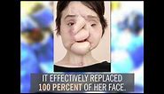 Katie Stubblefield's Face Transplant | By the Numbers