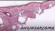 Angiosarcoma under the microscope (explained in 5 minutes) pathology dermpath dermatology