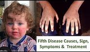 What is Fifth Disease ? Fifth Disease Causes, Sign Symptoms, Treatment