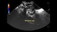 Ultrasound Shows Torsion of Paraovarian Cyst