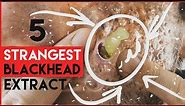 5 strangest, blackhead extract - One in ten 2020