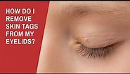 How Do I Remove Skin Tags from My Eyelids?