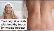 Treating skin rash and inflammation with healthy foods (Pityriasis Rosea)
