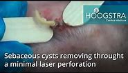 Sebaceous cysts removing through a minimal laser perforation
