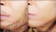 The shocking secret to removing facial hair permanently | Khichi Beauty