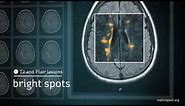Multiple Sclerosis: Understanding Your MRI