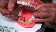 Rubber Tip Stimulator - Oral Hygiene Instructions by Dr. Berdy, periodontist Jacksonville, FL