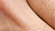 Human papilloma virus causing warts on the skin #kihuga #thw #TheHealthWise #healthwise #medical #viralreel | The HealthWise