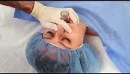 NuMask in Anesthesiology, IntraOral Mask (IOM®) / Oropharyngeal Airway (OPA) Training Video