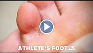 How To Treat Athlete's Foot - BioPed Footcare