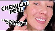 Getting a Vi Peel Chemical Peel & Non-Surgical Neck Lift! | Skincare with Susan Yara