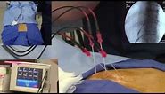 Radiofrequency Ablation Explanation Video Demonstration - LIVE!