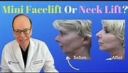 Reasons for a Mini Facelift or Neck Lift Surgery | Plastic Surgeon's Opinion