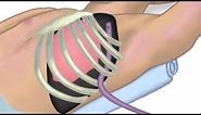 "Chest Tube Placement" by Chris Weldon for OPENPediatrics