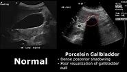 Gallbladder Ultrasound Normal Vs Abnormal Image Appearances Comparison | Gallbladder Pathologies