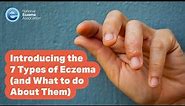 Introducing the 7 Types of Eczema (and What to do About Them)