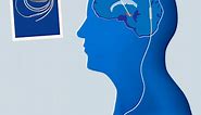 Deep Brain Stimulation Coding in CPT: Maximizing Your Understanding