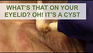 What's that on your eyelid? Oh! It's a Cyst | Dr. Derm