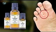 How To Get Rid Of Warts Fast with Healing Natural Oils H-Warts Formula