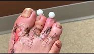 Removing pins from foot | Dr. Nicholas Campitelli