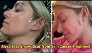 Alexa Bliss Shows Scar from Skin Cancer Treatment