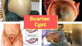 Ovarian Cyst Symptoms? Causes, Pictures Signs and Symptoms of Ovarian Cysts