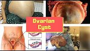 Ovarian Cyst Symptoms? Causes, Pictures Signs and Symptoms of Ovarian Cysts