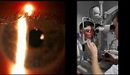 Slit Lamp: Optical Section and Parallelpiped
