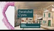 Paratubal Cysts