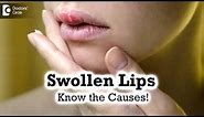 Swollen Lips: Common Causes,Triggers | Angioedema - Dr. Rashmi Ravindra | Doctors' Circle