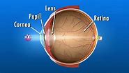 Nearsightedness: What Is Myopia?