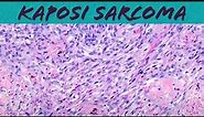 Kaposi sarcoma (vascular tumor pathology histology dermpath dermatology dermatopathology HIV AIDS)