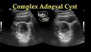 Complex Adnexal Cyst || Ultrasound || Case 27
