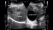 Ultrasound Video showing Metastatic ovarian cancer.